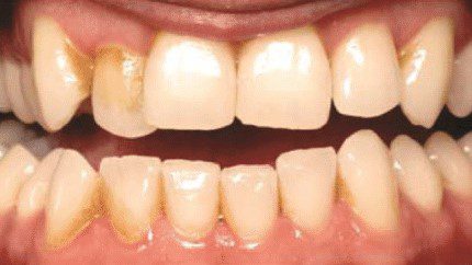 Extrinsic stained teeth