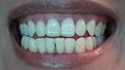 Intrinsic teeth stain