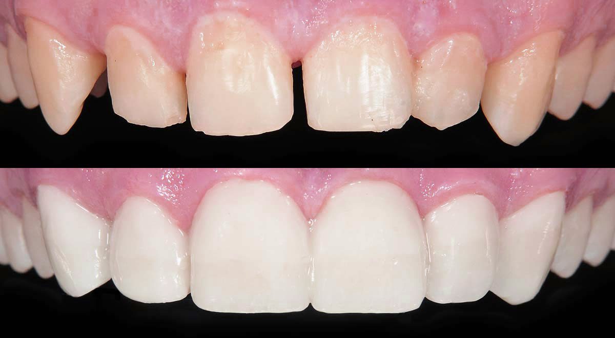 dental bonding dental bonding