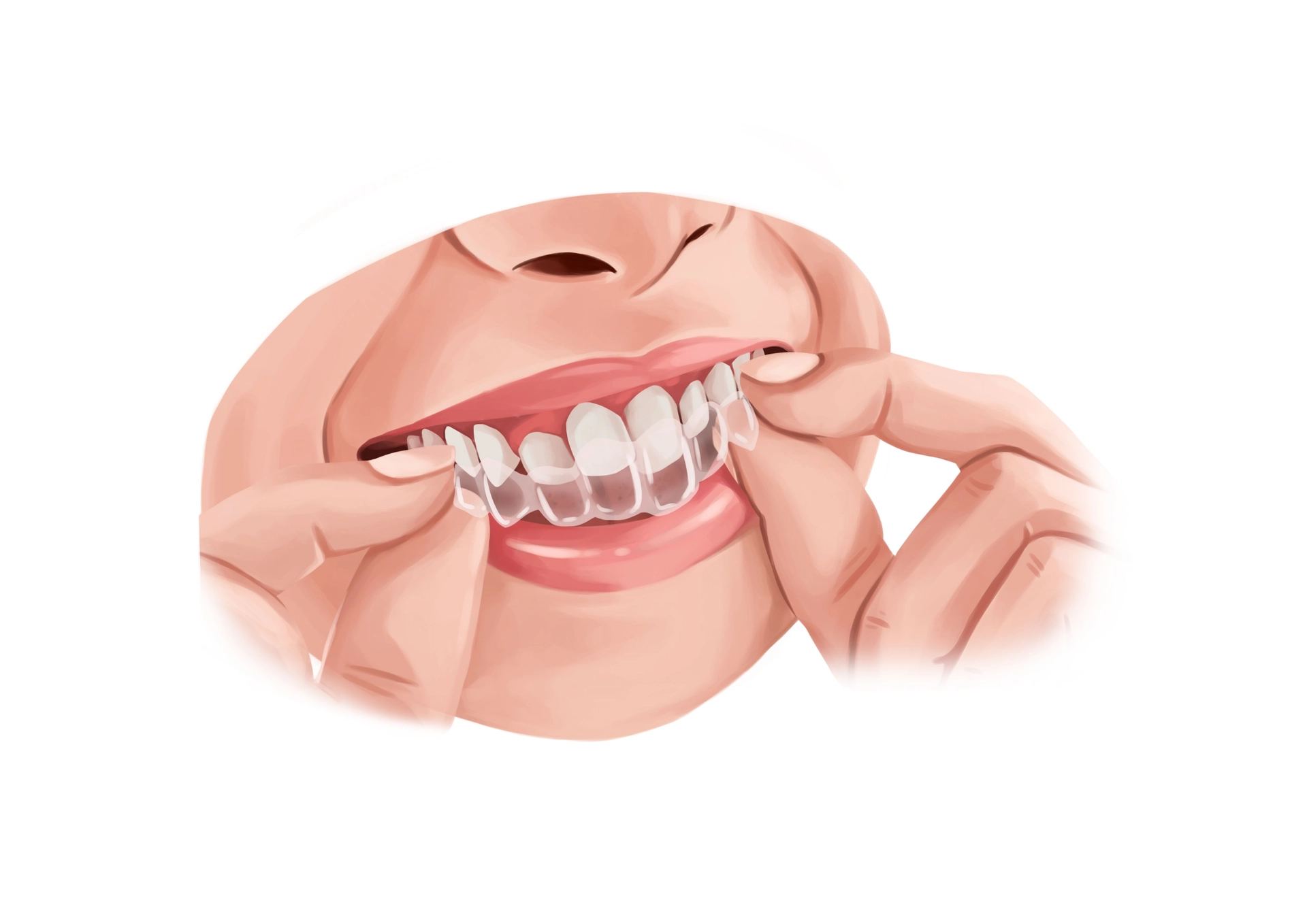dental bone grafting required before dental implant placement due to bone loss in the jaw