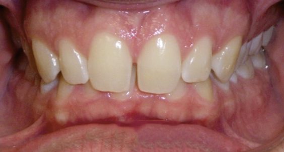 Overbite
