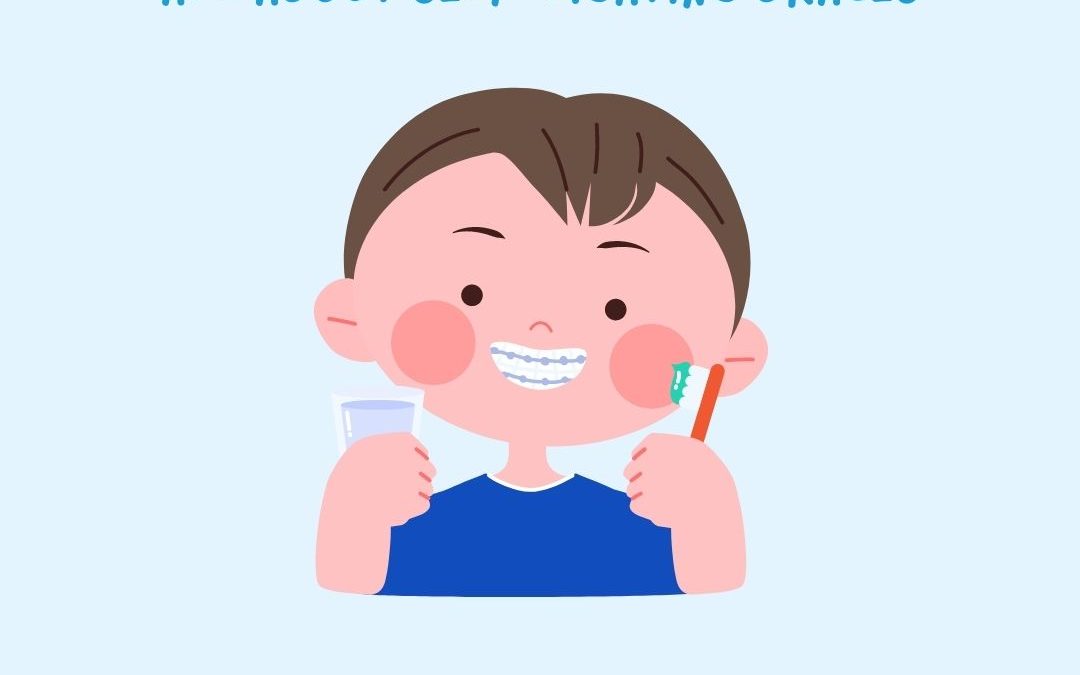 self ligating braces