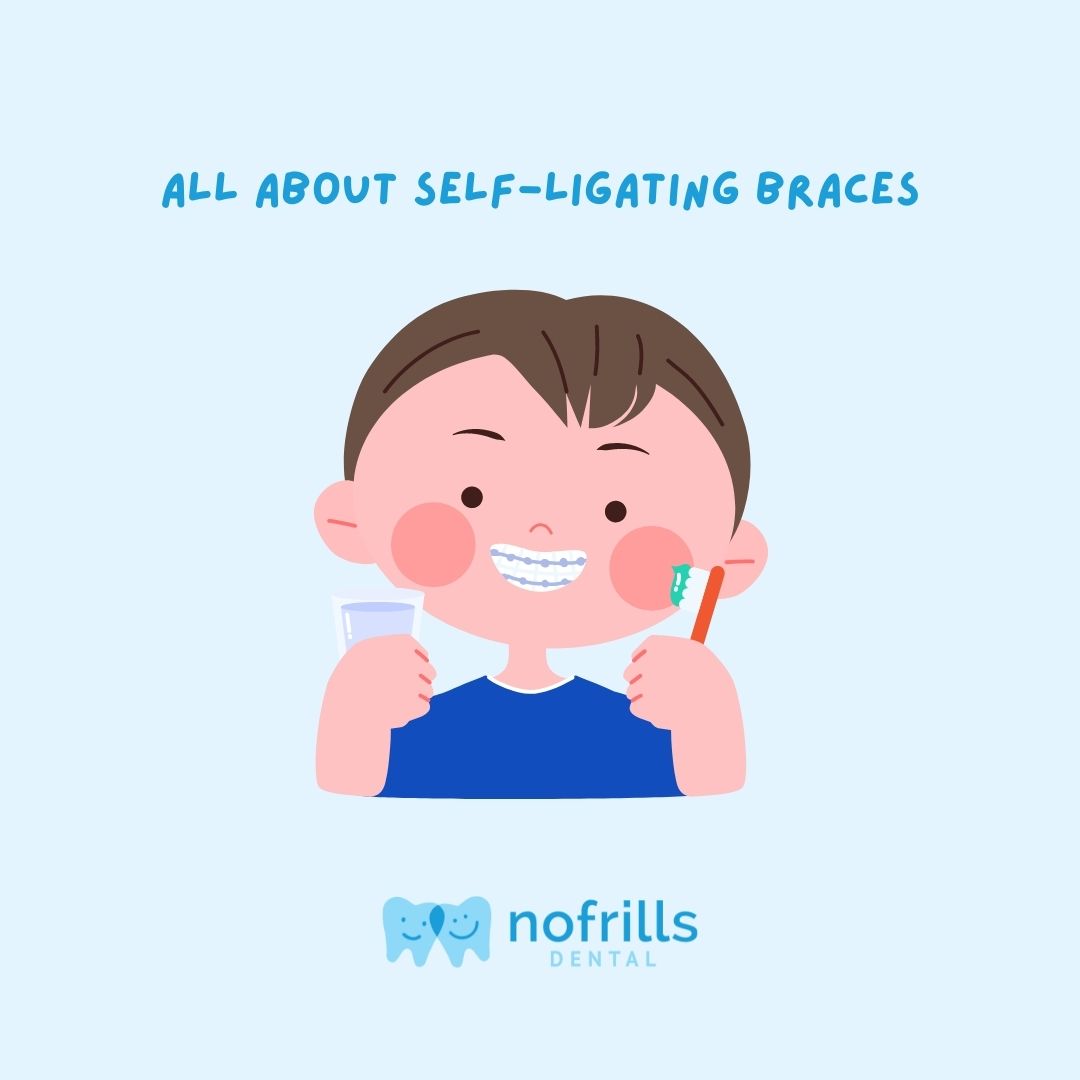 self ligating braces