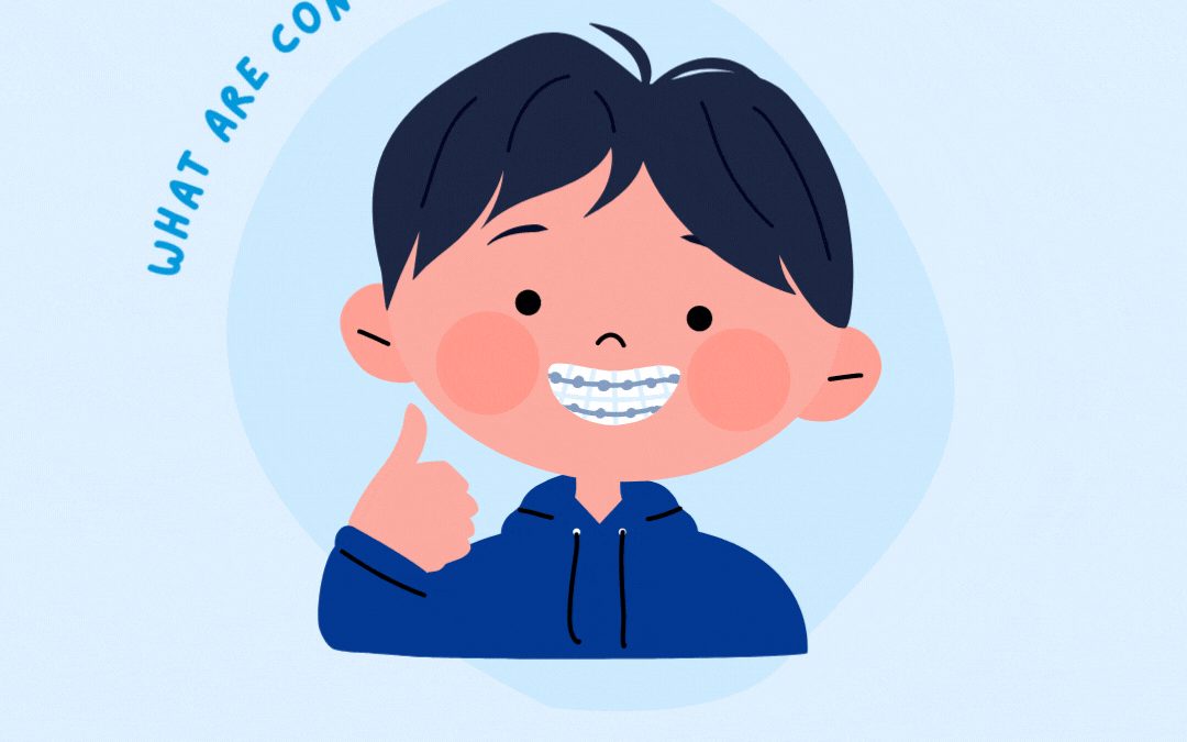 understanding conventional braces