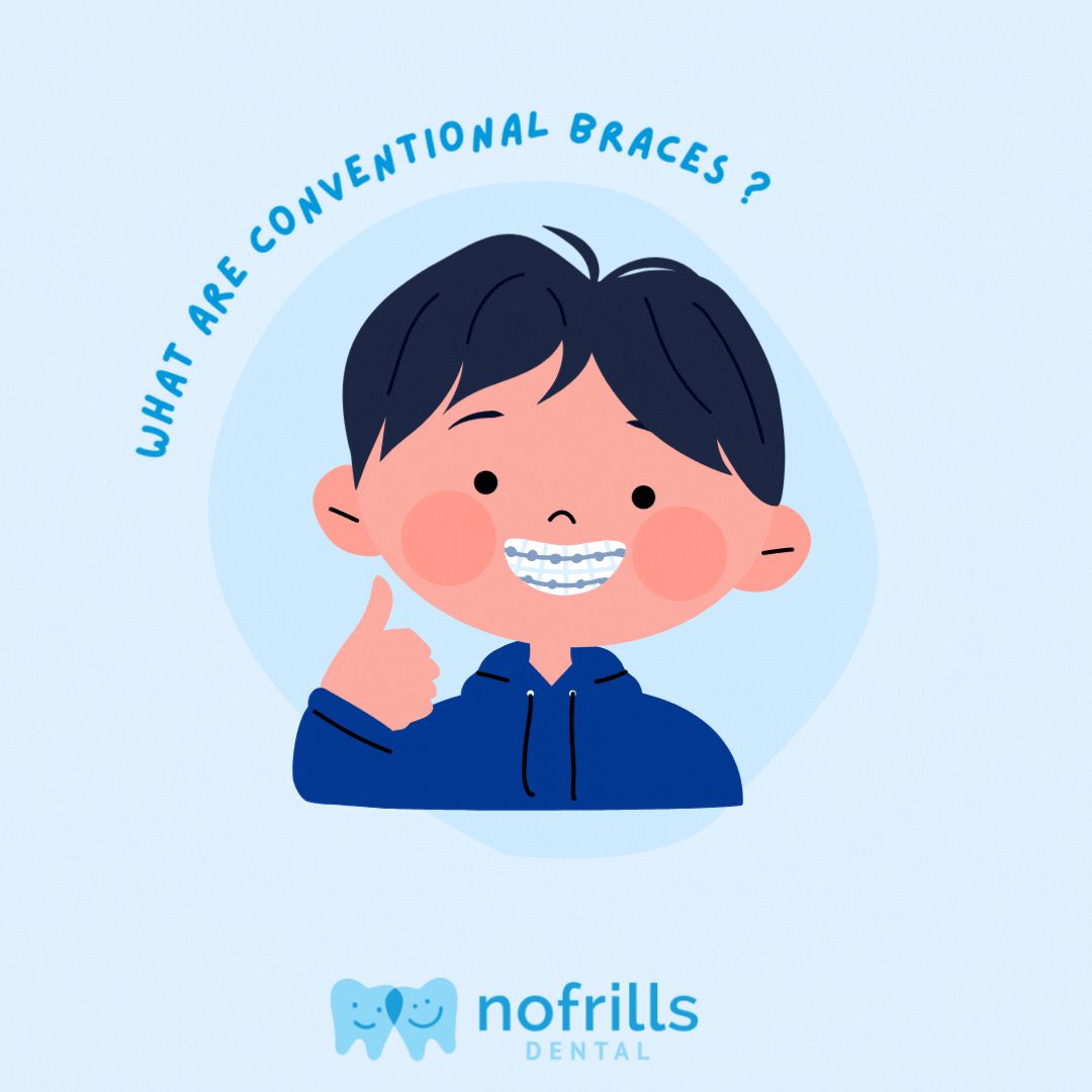 understanding conventional braces