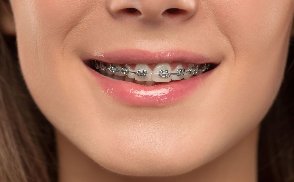 advantages of braces woman suffering from implant allergy