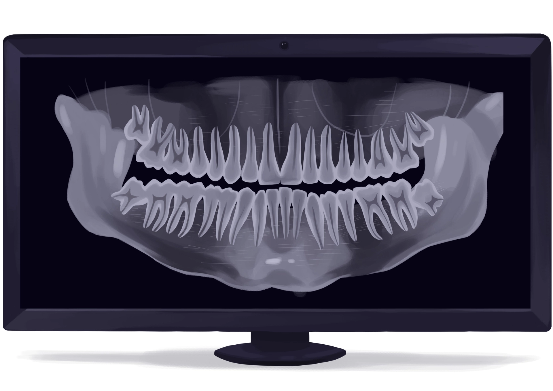 dental implant placement process
