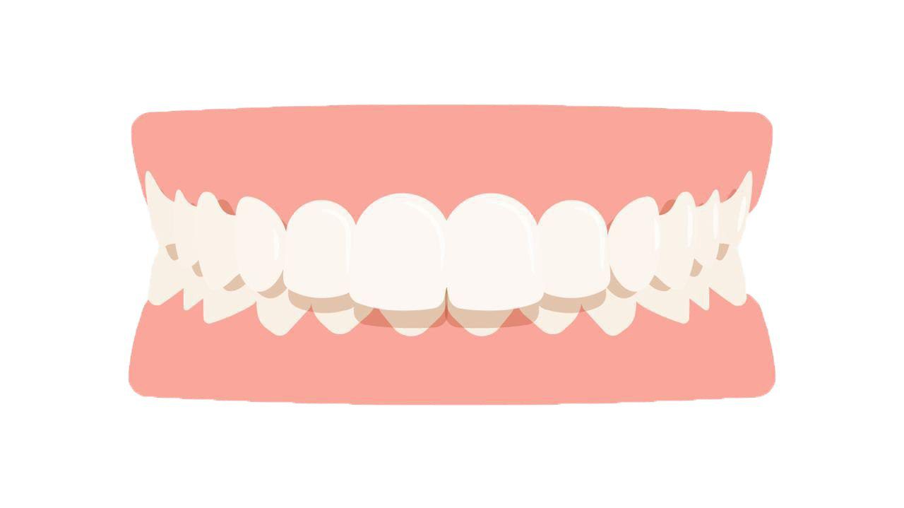 overbite
