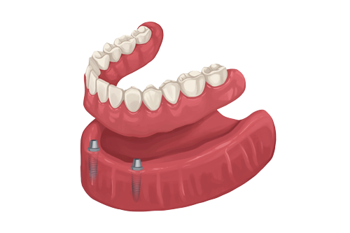 two-implant-overdenture
