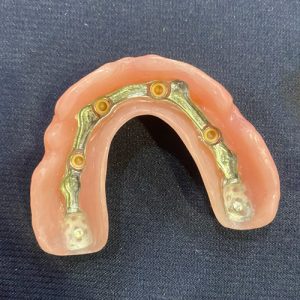 Inside Overdenture