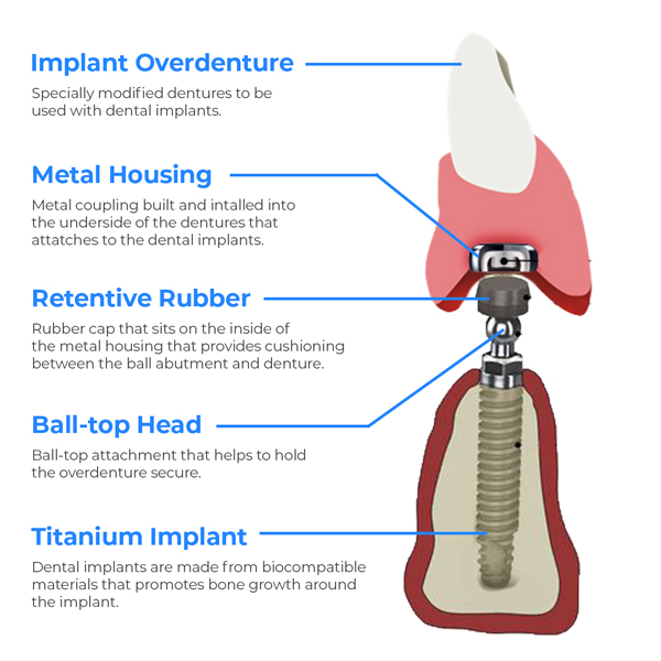 Overdentures explained