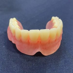 Implant Overdenture