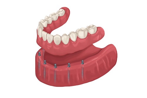 overdenture