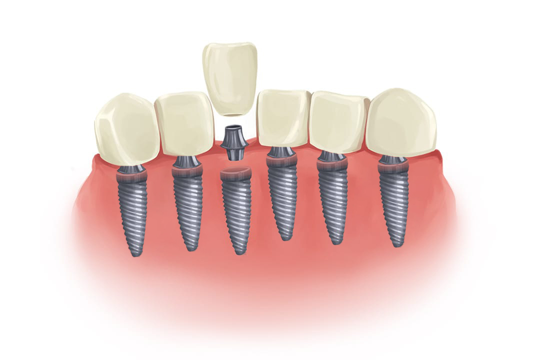 Implants for all teeth