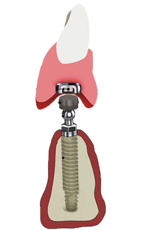 ball attachment overdenture cross section