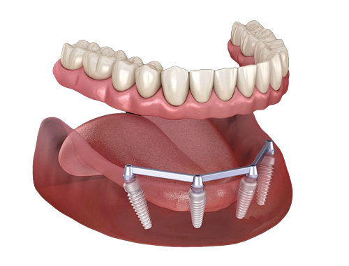 bar implant overdenture