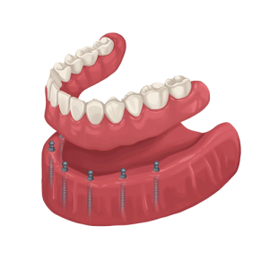 Single Implant Overdenture