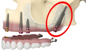 Pterygoid Dental Implant