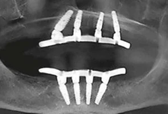 All-On-4 Dental Implant 