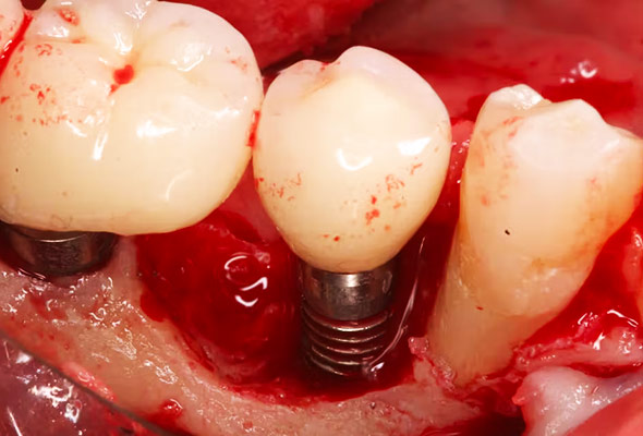 Dental Implant Infection