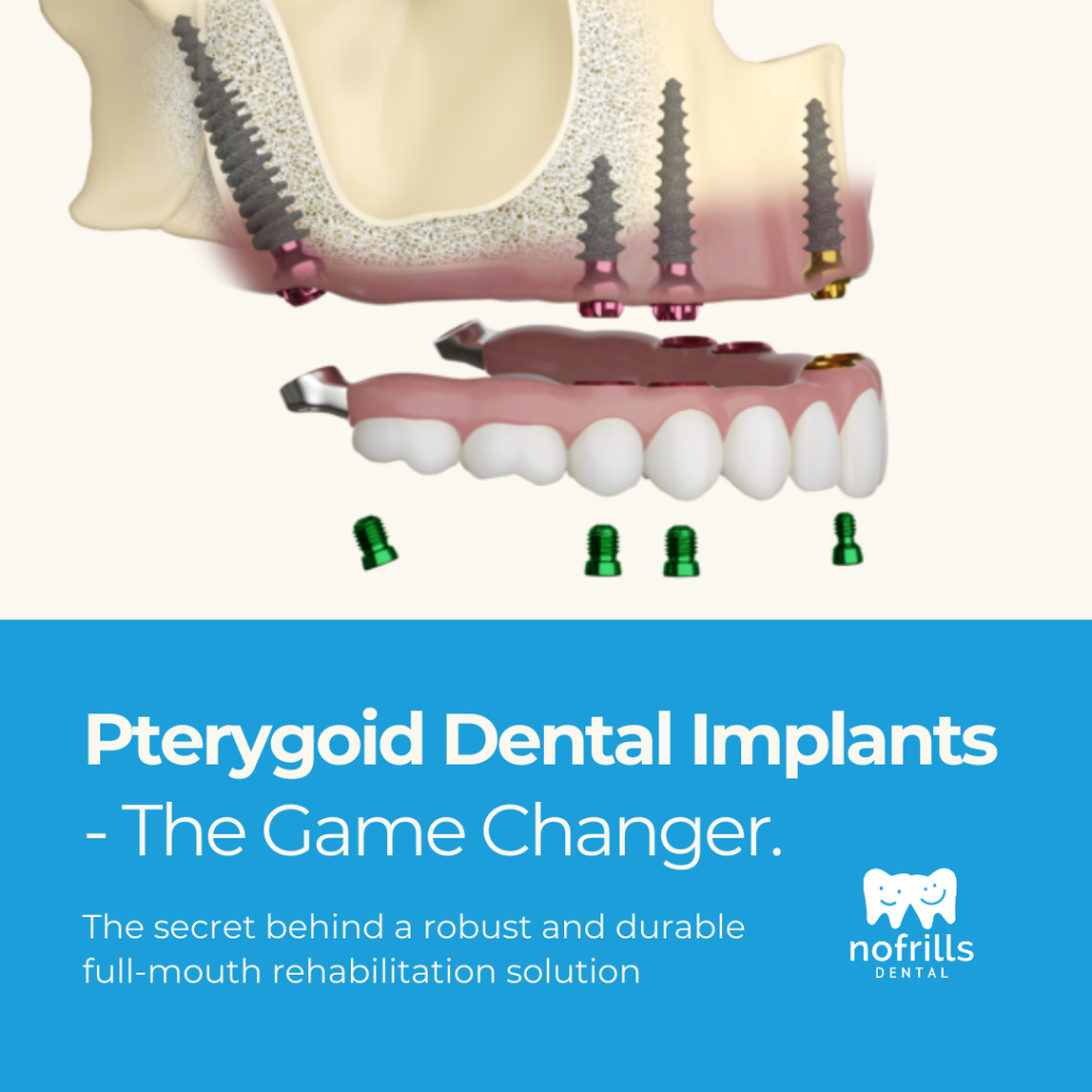 Pterygoid Dental Implants - The Game Changer