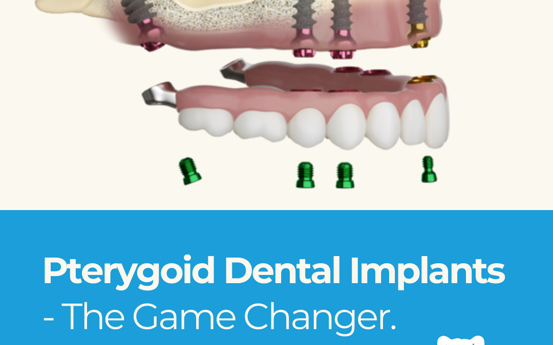 Pterygoid Dental Implants - The Game Changer