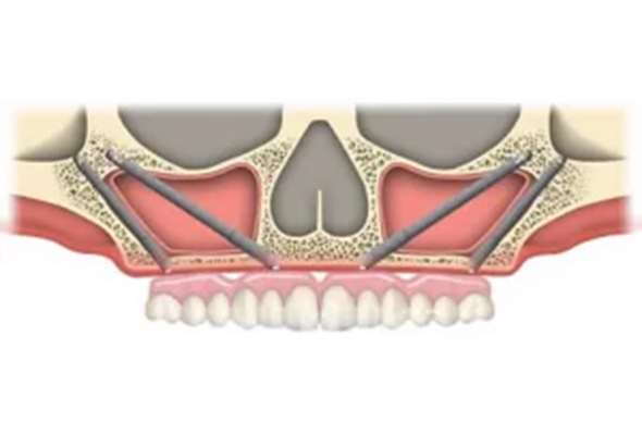 Zygomatic Implant vs Pterygoid Implants