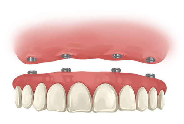 all on 4 dental implants in Singapore