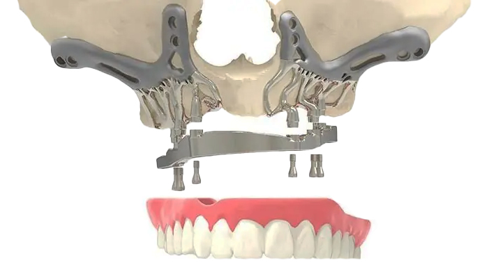Subperiosteam-Dental-Implants Subperiosteal Dental Implant