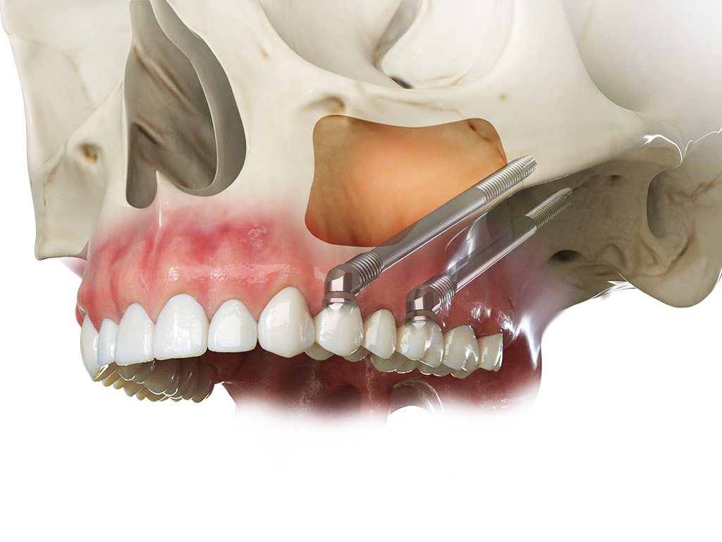 zygomatic_implants Double Zygomatic Dental Implants with Bridge