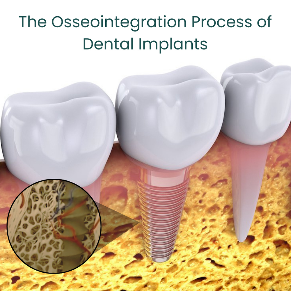 osseointegration-process-of-dental-implants