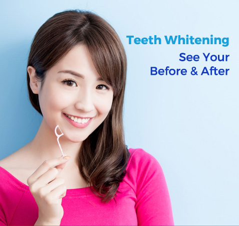 TEETH WHITENING